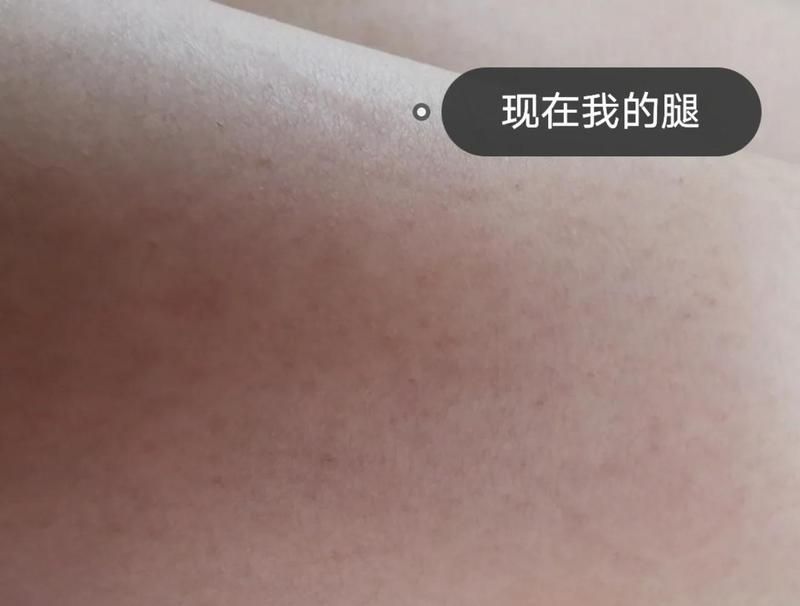 有哪些品牌治療爛鱗的藥物推薦，皮膚疾病治療之爛鱗