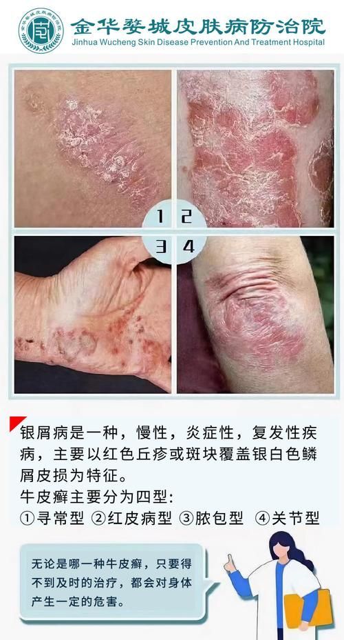 有哪些品牌治療爛鱗的藥物推薦，皮膚疾病治療之爛鱗