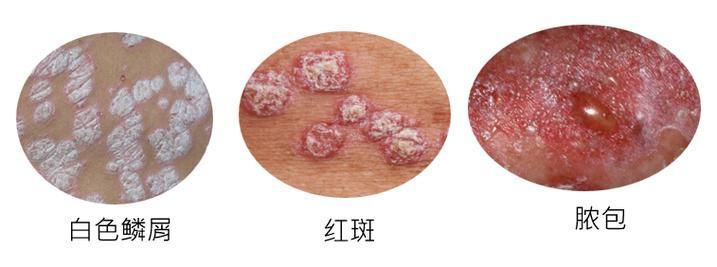 有哪些品牌治療爛鱗的藥物推薦，皮膚疾病治療之爛鱗