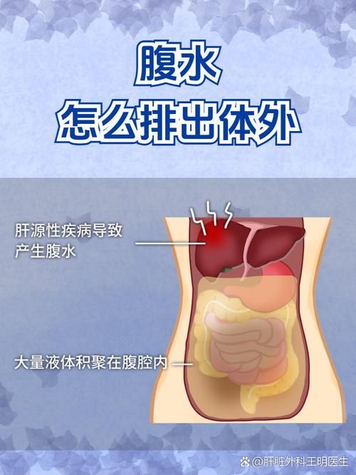 腹水患者應該如何就醫，腹水患者如何就醫