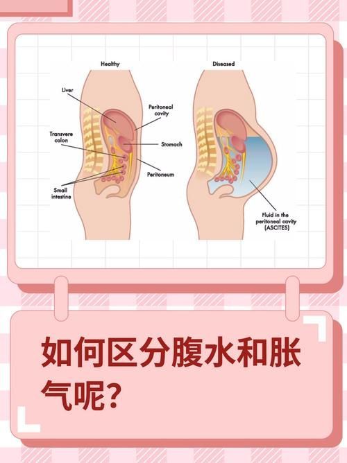 腹水患者應該如何就醫，腹水患者如何就醫
