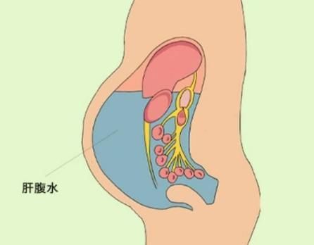 腹水患者應該如何就醫，腹水患者如何就醫