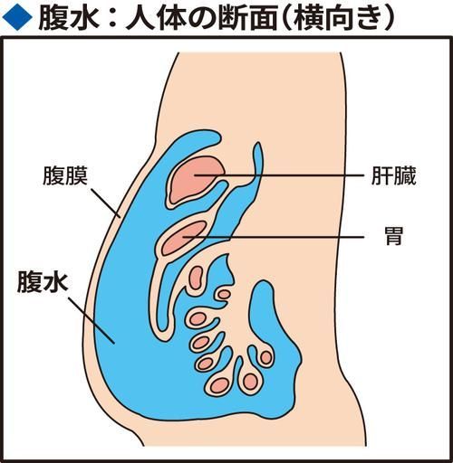 腹水患者應該如何就醫，腹水患者如何就醫
