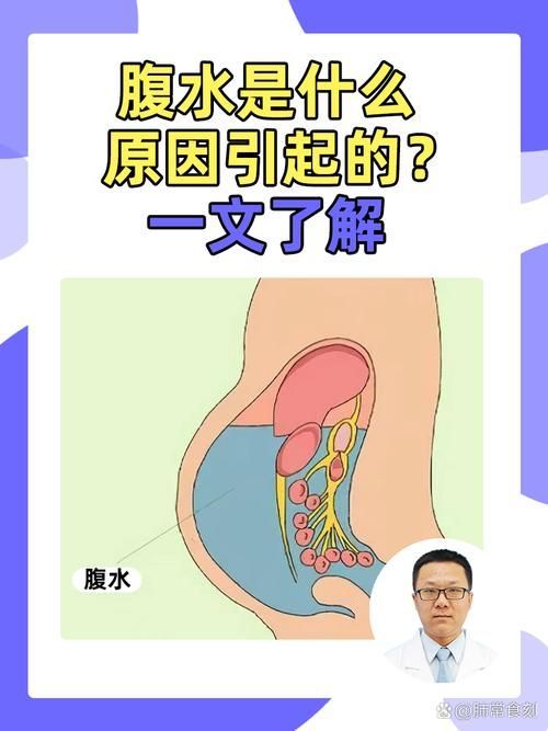 腹水患者應該如何就醫，腹水患者如何就醫