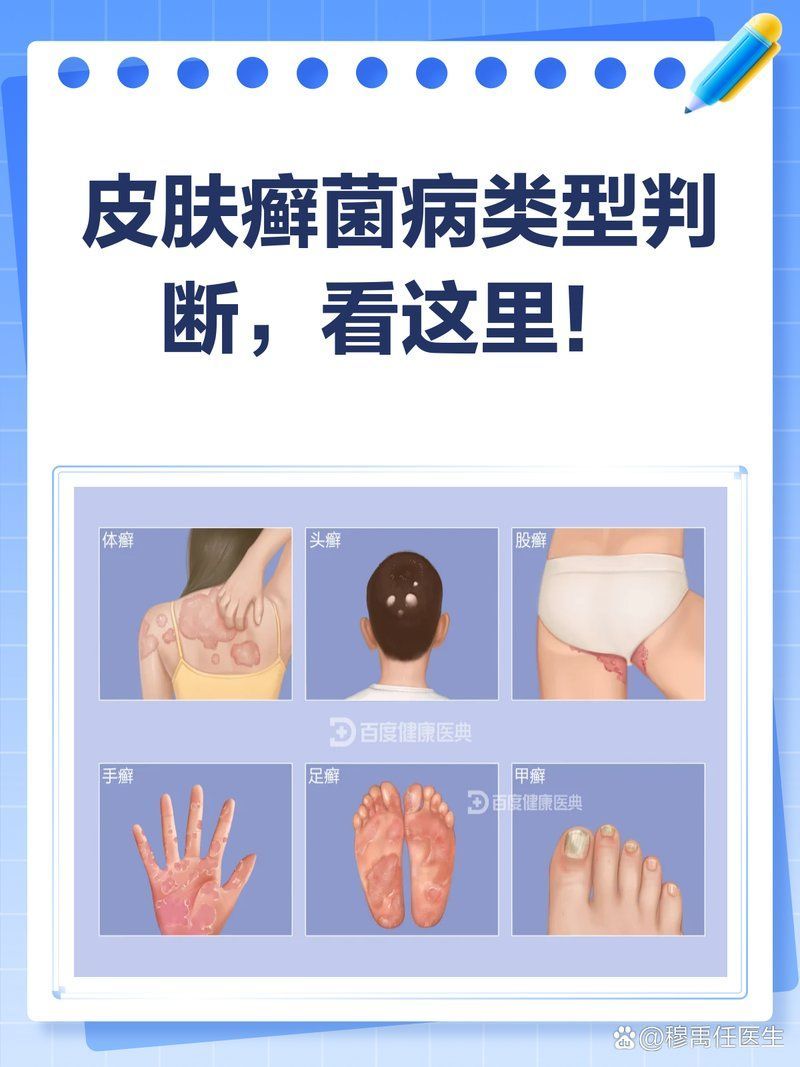 如何判斷自己是否感染了皮膚癬菌病，如何判斷自己是否感染了皮膚癬菌病皮膚癬菌病的典型表現