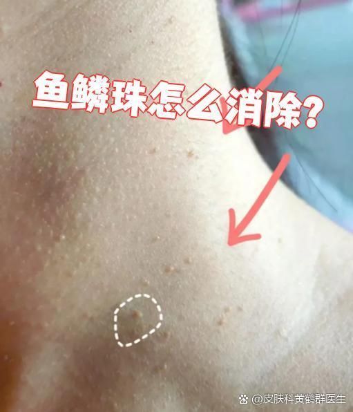 哪種方法去除魚(yú)鱗珠最快，哪種方法去除魚(yú)鱗珠最快本探討了快速去除魚(yú)鱗珠的方法