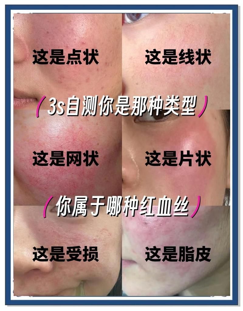 如何判斷自己的紅血絲類型，如何判斷自己的紅血絲類型，如何區(qū)分單純毛細(xì)血管擴(kuò)張和疾病伴隨型