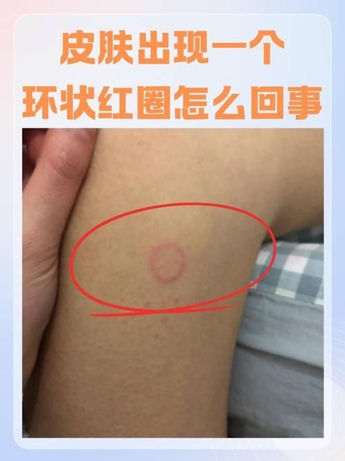 如何預防和治療皮膚癬菌病，關于皮膚癬菌病治療的一些建議