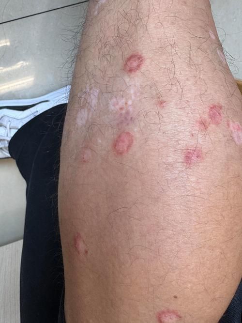 如何預防和治療皮膚癬菌病，關于皮膚癬菌病治療的一些建議