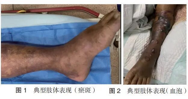 海水細菌感染怎么治療，海水細菌感染怎么辦
