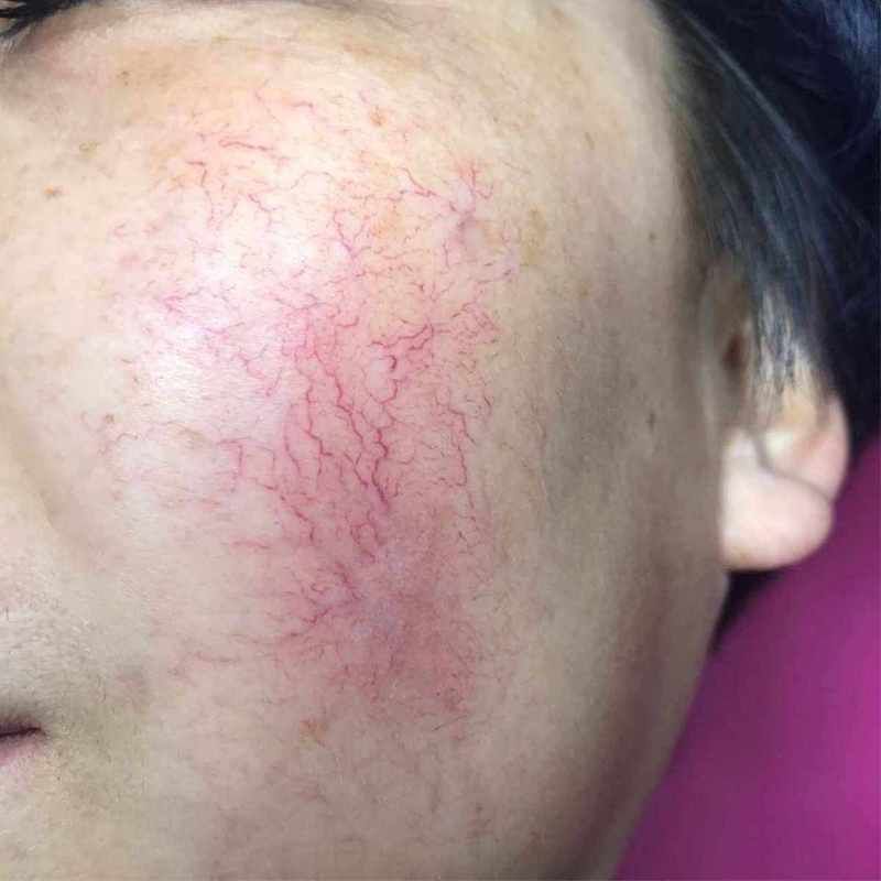 如何判斷自己的紅血絲類型，如何判斷自己的紅血絲類型共調用2個工具