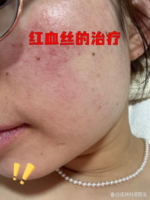 如何判斷自己的紅血絲類型，如何判斷自己的紅血絲類型共調用2個工具