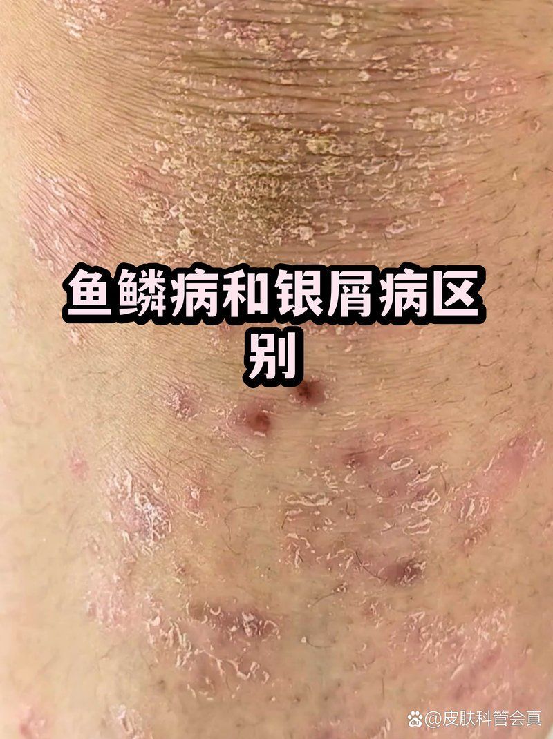 如何區分魚鱗病和銀屑病，魚鱗病和銀屑病的區別