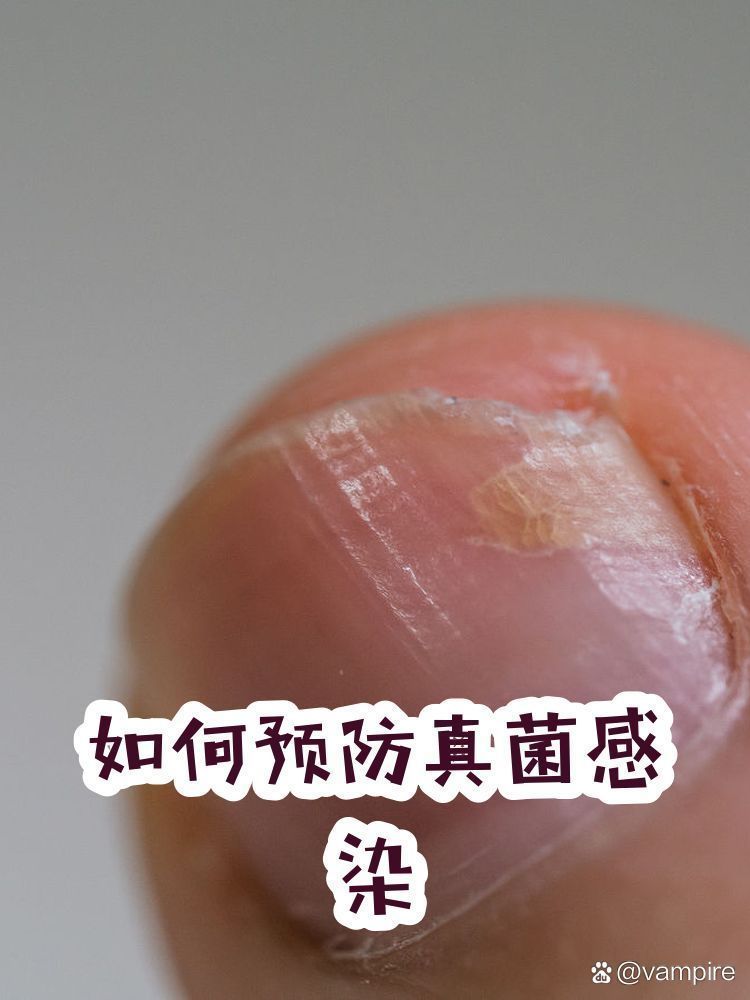 如何預(yù)防深部真菌感染，深部真菌感染的預(yù)防措施