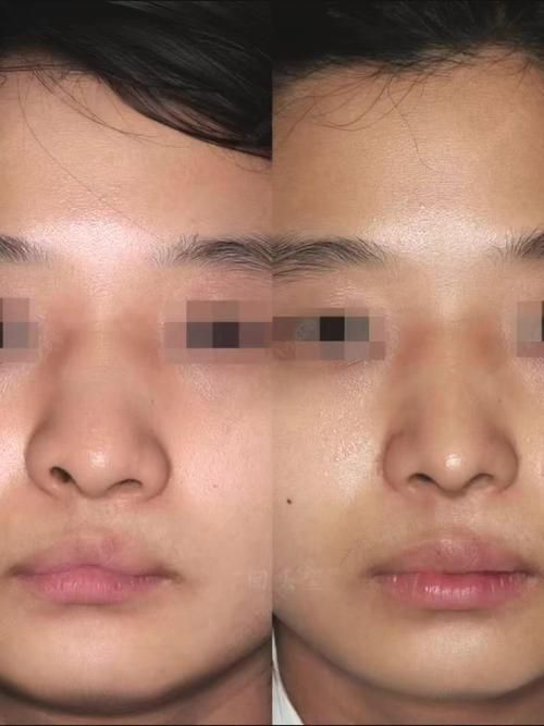 手術矯正龍魚嘴需要多長時間恢復？，手術矯正“龍魚嘴”