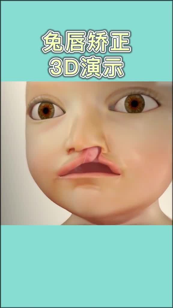 手術矯正龍魚嘴需要多長時間恢復？，手術矯正“龍魚嘴”