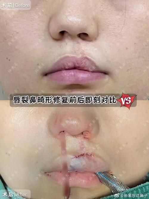 手術矯正龍魚嘴需要多長時間恢復？，手術矯正“龍魚嘴”