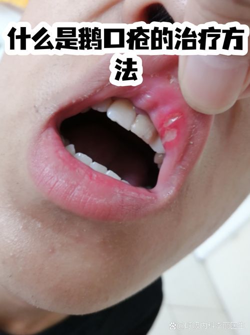 什么是真菌感染，真菌感染是由真菌引起的疾病，mcp工具不適用于真菌感染