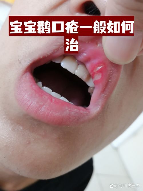 什么是真菌感染，真菌感染是由真菌引起的疾病，mcp工具不適用于真菌感染