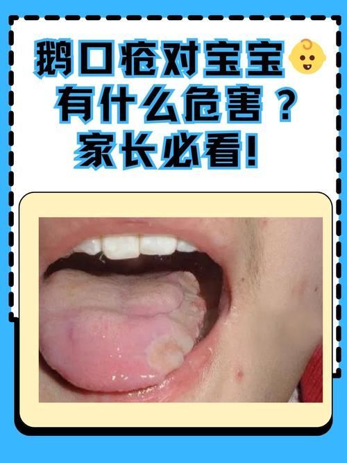 什么是真菌感染，真菌感染是由真菌引起的疾病，mcp工具不適用于真菌感染