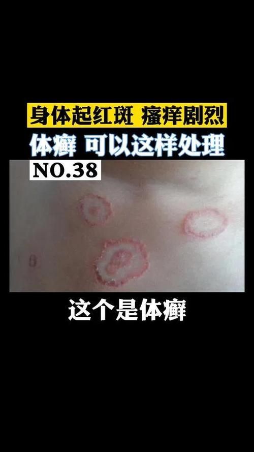 什么是真菌感染，真菌感染是由真菌引起的疾病，mcp工具不適用于真菌感染
