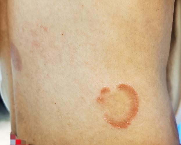 什么是真菌感染，真菌感染是由真菌引起的疾病，mcp工具不適用于真菌感染