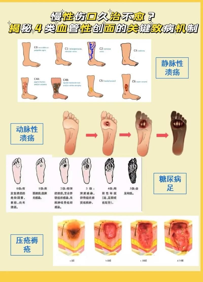 非感染性爛尾如何護(hù)理，“非感染性爛尾”如何護(hù)理