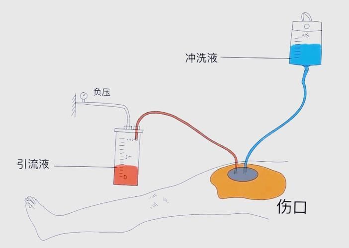 非感染性爛尾如何護(hù)理，“非感染性爛尾”如何護(hù)理
