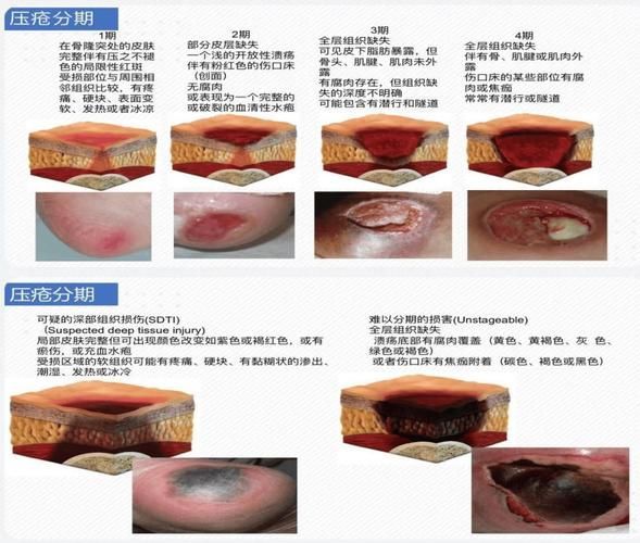 非感染性爛尾如何護(hù)理，“非感染性爛尾”如何護(hù)理