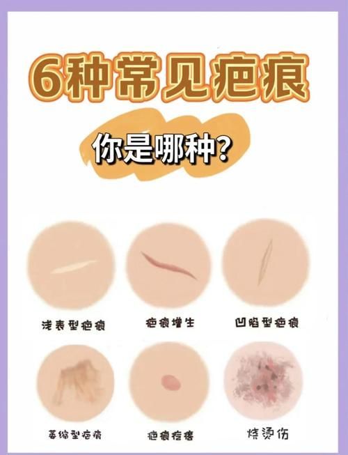 非感染性爛尾如何護(hù)理，“非感染性爛尾”如何護(hù)理