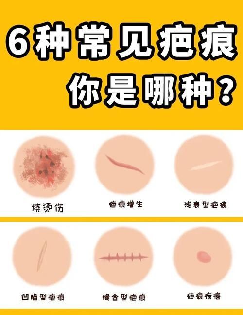 非感染性爛尾如何護(hù)理，“非感染性爛尾”如何護(hù)理