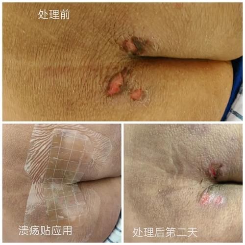 非感染性爛尾如何護(hù)理，“非感染性爛尾”如何護(hù)理