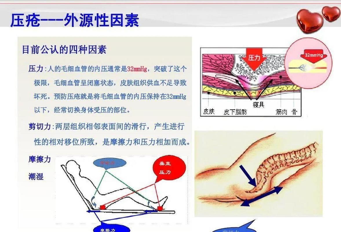 非感染性爛尾如何護(hù)理，“非感染性爛尾”如何護(hù)理