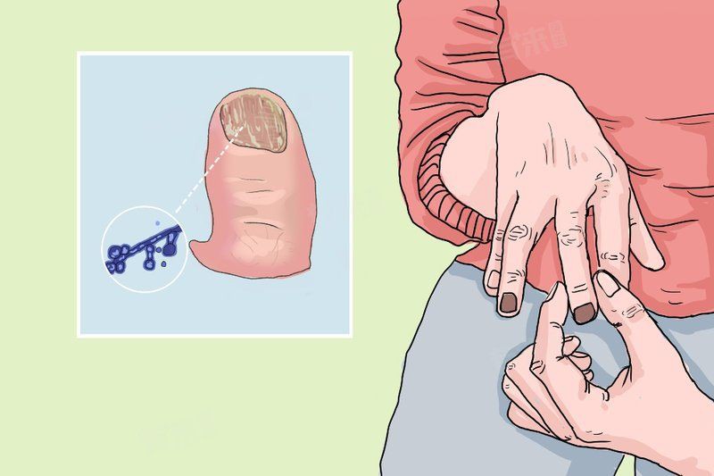 真菌和細菌感染哪個更常見？，真菌感染和細菌感染的區別