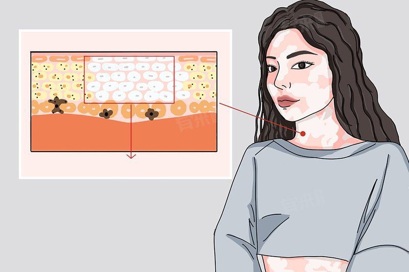 有哪些有效的白點病治療方法？，權威醫生專家意見白點病的治療方法張桂英主任醫師三甲如何治療