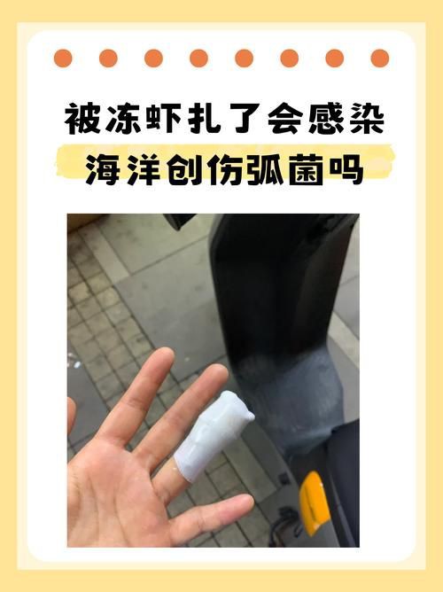 有沒有海洋弧菌感染的早期圖片？：創傷弧菌感染早期皮膚表現可通過以下圖片集直觀展示