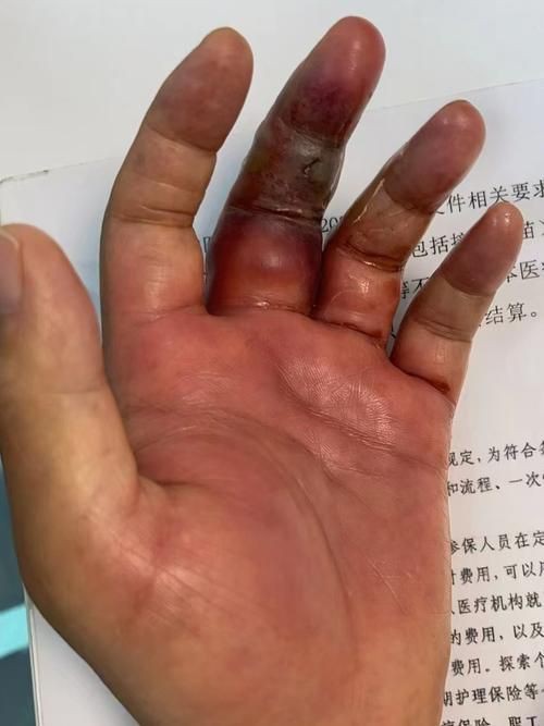 有沒有海洋弧菌感染的早期圖片？：創傷弧菌感染早期皮膚表現可通過以下圖片集直觀展示