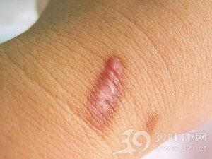 魚鱗變紅滲血會留下疤痕嗎？【魚鱗變紅滲血會留下疤痕嗎】 魚鱗變紅滲血會留下疤痕嗎？【魚鱗變紅滲血會留下疤痕嗎】 龍魚百科