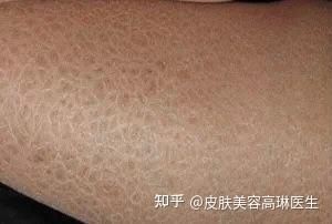 魚(yú)鱗病一般活不過(guò)40歲嗎【關(guān)于“魚(yú)鱗病一般活不過(guò)40歲”的說(shuō)法缺乏科學(xué)依據(jù)】