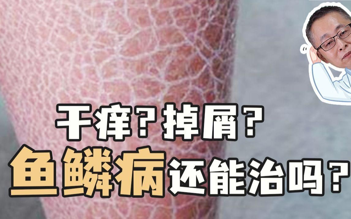 魚鱗充血用什么藥【楊希川教授】一挽褲腳就下雪,魚鱗病還能治嗎】