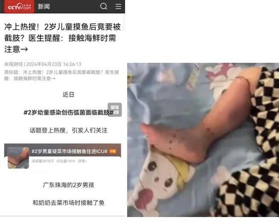 魚真菌病會傳染給人類嗎？【澎湃新聞,幼童摸魚面臨截肢風險,罪魁禍首竟是它】