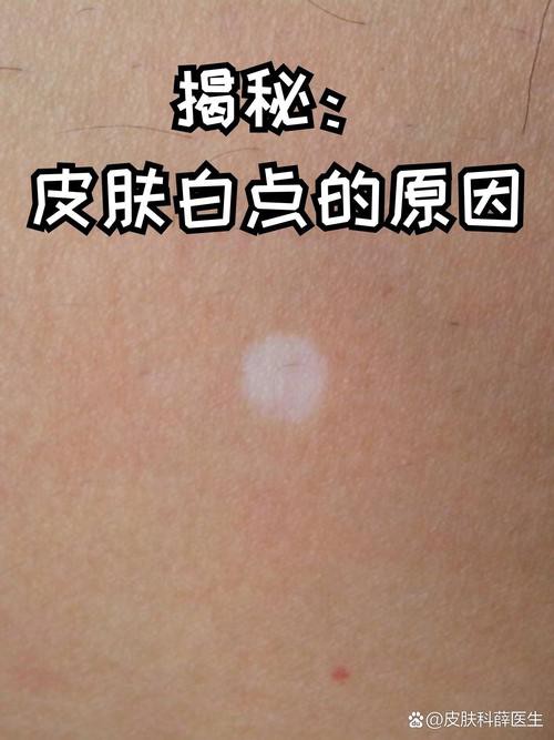 白點病初期圖片【寶寶脖子上有白色小圓點是怎么回事】