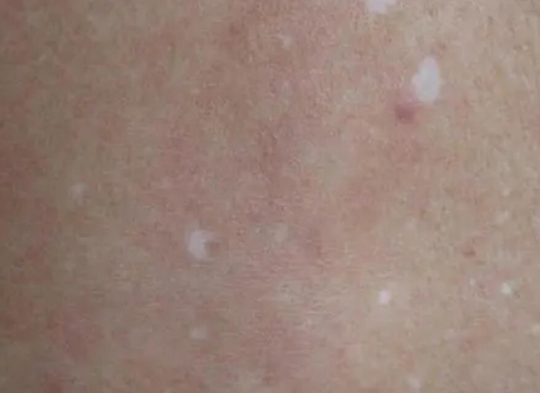 白點病初期圖片【寶寶脖子上有白色小圓點是怎么回事】