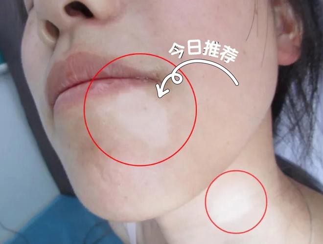 白點病初期圖片【寶寶脖子上有白色小圓點是怎么回事】