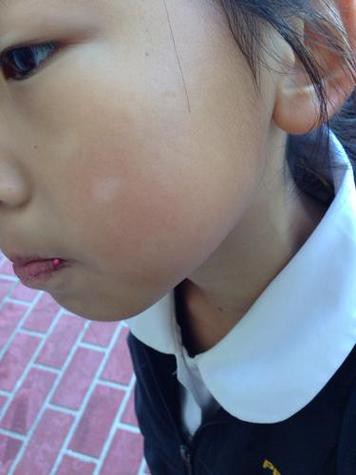 白點病初期圖片【寶寶脖子上有白色小圓點是怎么回事】