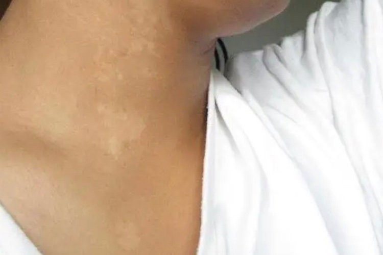 白點病初期圖片【寶寶脖子上有白色小圓點是怎么回事】