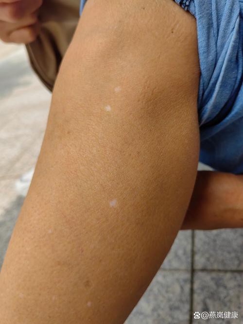 白點病初期圖片【寶寶脖子上有白色小圓點是怎么回事】