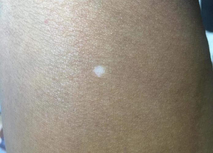 白點病初期圖片【寶寶脖子上有白色小圓點是怎么回事】