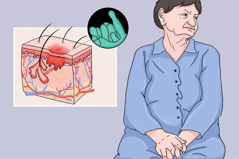 深部真菌感染有哪些常見(jiàn)類型？【什么是深部真菌感染】