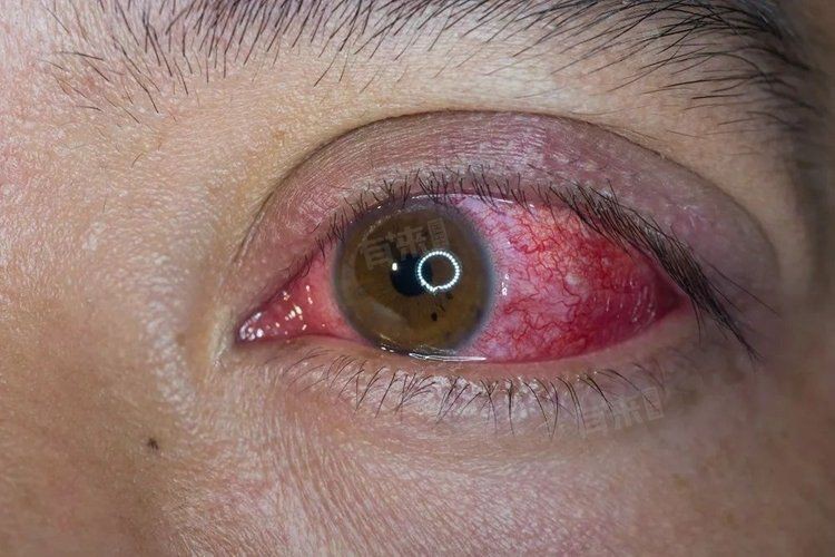 木赤是什么癥狀，《木赤是什么癥狀》